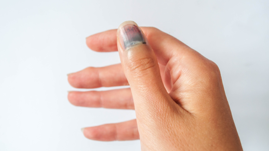 Det är inte ovanligt att nageln, vid blå nagel, lossnar från huden efter ett par veckor.  Foto: Shutterstock